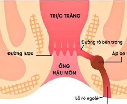  Giới thiệu về bệnh rò hậu môn